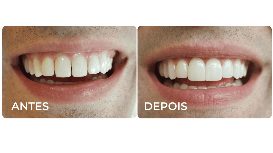 RESULTADOS IMPLANTES, PORCELANAS DOS ENTES