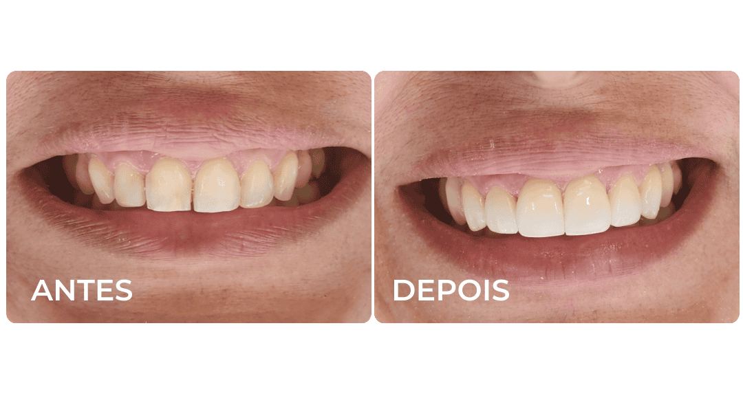 RESULTADOS IMPLANTES, PORCELANAS DOS ENTES