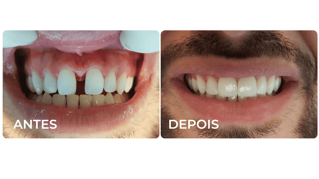 RESULTADOS IMPLANTES, PORCELANAS DOS ENTES